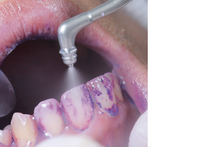 図5: ステインの状態に応じて、パウダー量（パワー）と水量をそれぞれ10段階で調整でき、小さく扱いやすいヘッドで操作が容易です。