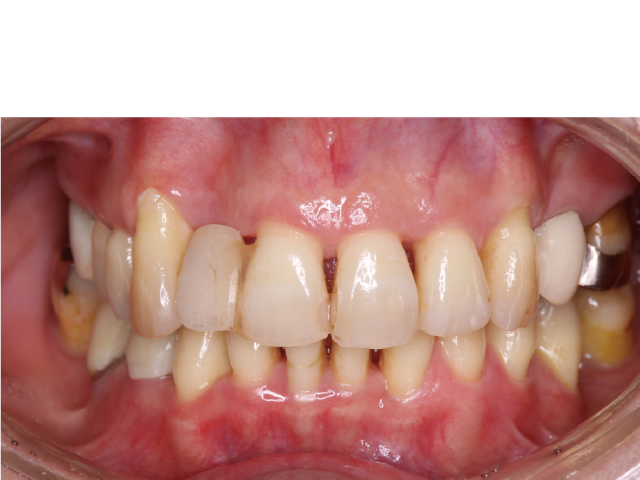 矯正後メインテナンス時（補綴治療中）
