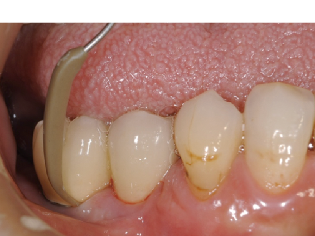 ブラケットが外れた後のメインテナンス