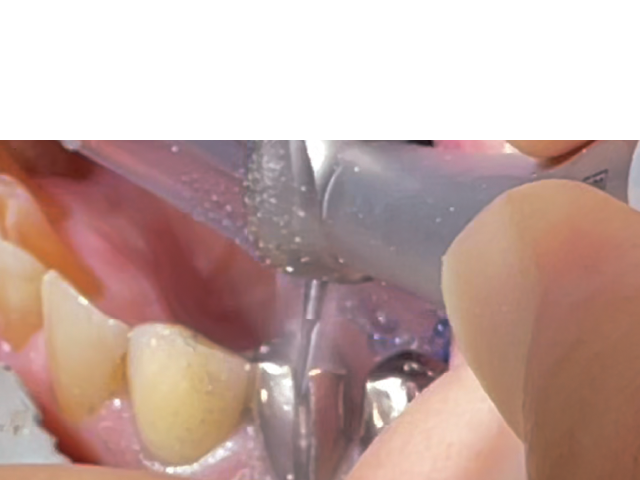 図1 : Z990Lを使用したメタルクラウン除去。