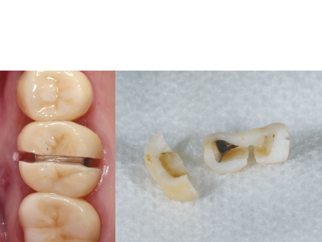 図2 : ジルコニア修復装置の除去。