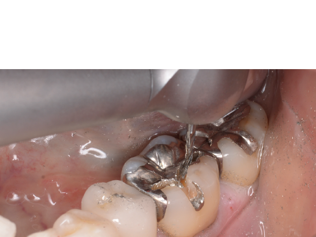 図3 : Z990Lを使用したメタルインレーの除去。窩壁に薄く一層メタルを残す。