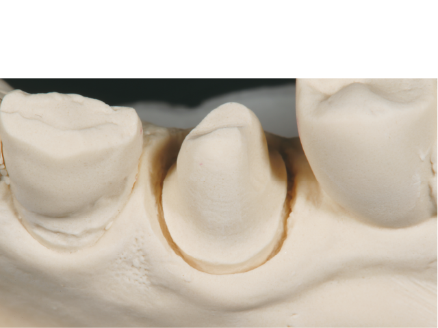 図4 : 模型上の明瞭なフィニッシュライン。