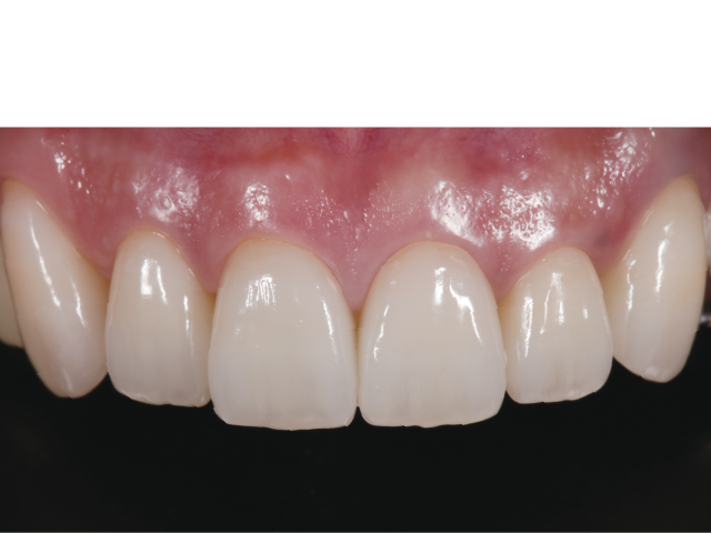 図5 :  支台歯形成時の正しいフィニッシュラインの設定位置が補綴装置の適合性を高め、周囲と調和する形態を引き出す。