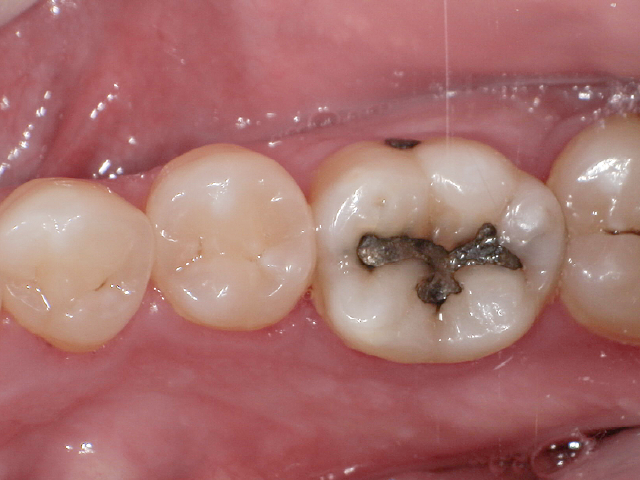 術前。 36旧アマルガム修復材料の審美障害が主訴。