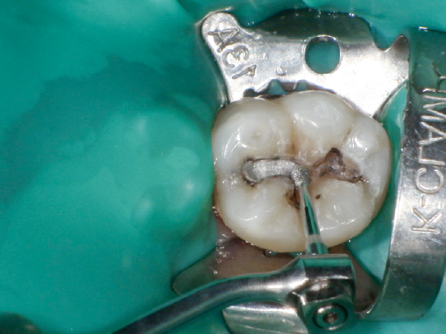 ラバーダム設置後、エアースケーラーチップにてアマルガム修復材料を撤去。