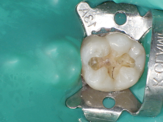 アマルガム修復材料の撤去後、感染象牙質も除去。