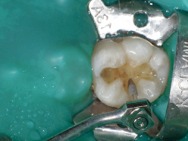 裂溝部の着色を除去：Vチップホルダー（S75）・ファイン ダイヤモンドコーティングチップ（V-G78）