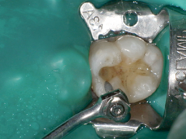 窩縁部の整理：Vチップホルダー（S75）・スーパーファイン ダイヤモンドコーティングチップ（V-G79）