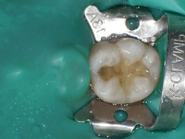 窩洞形成終了後。