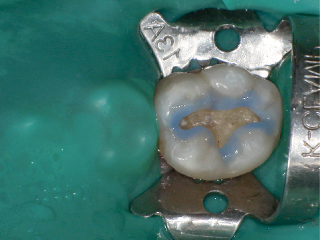 窩縁部エナメル質へのリン酸エッチング処理。