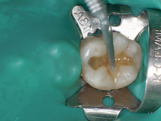 水洗・乾燥後、2ステップタイプのセルフエッチングプライマーを塗布。