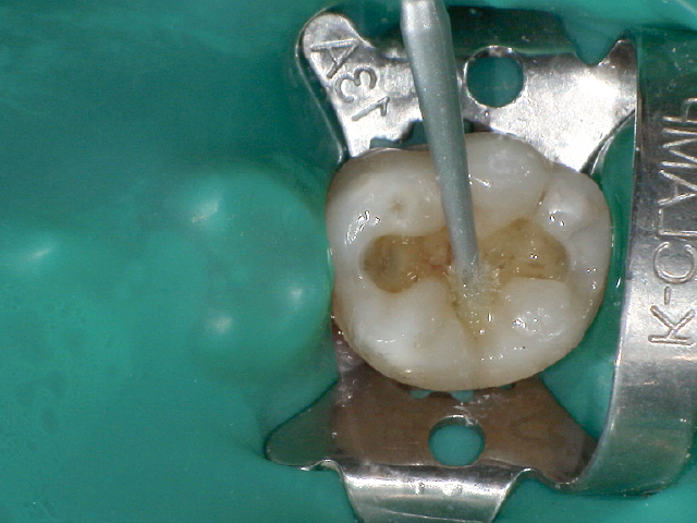 2ステップタイプのボンディング材を塗布。