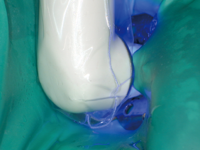 エアーブロー後、光照射。