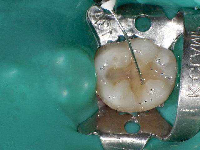 積層充填の第1層目として、窩洞底部へのフロアブルCRの充填。