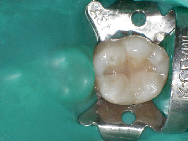 積層充填の第2層目として、舌側部へのペーストタイプCRの充填。