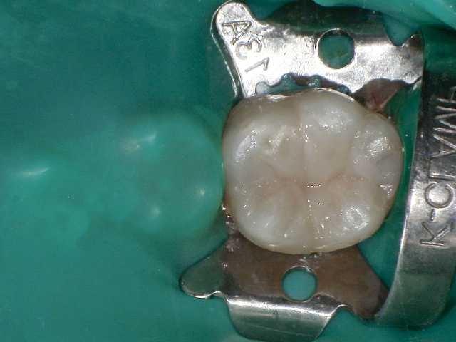 積層充填の第2層目として、頬側部へのペーストタイプCRの充填。