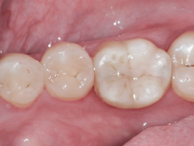 術後。メタルフリー修復を完了。