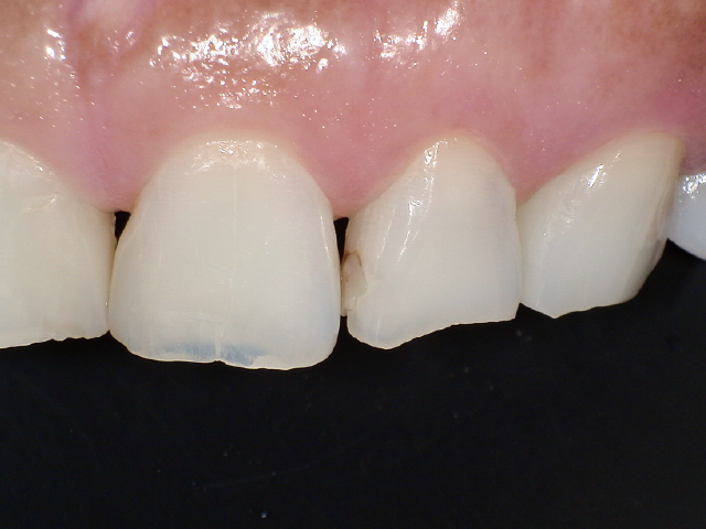 術前。12旧コンポジットレジン修復材料の変色を主訴に来院。