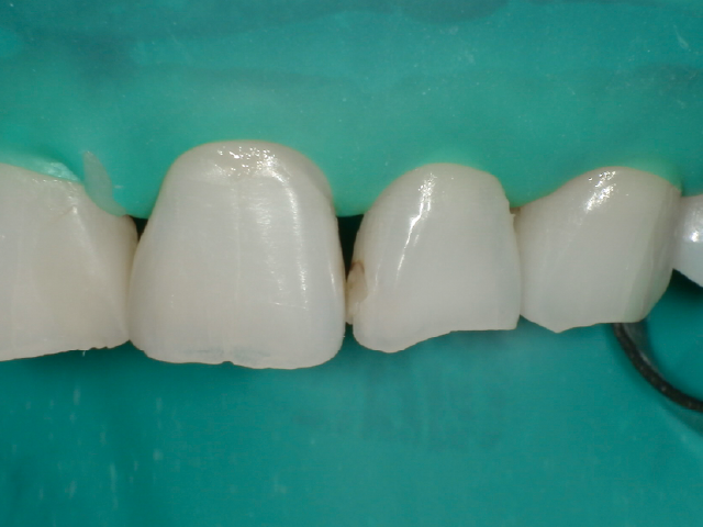 ラバーダムシステムの設置。