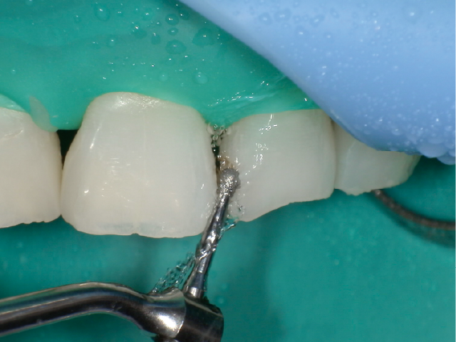 う蝕除去用のエアースケーラーチップ：Vチップホルダー（S75）・ラウンドタイプ ダイヤモンドコーティングチップ（V-G71）