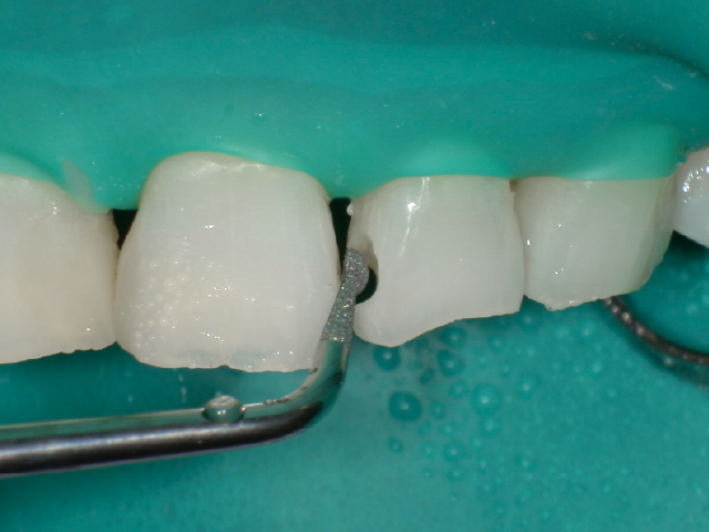 隣在歯の誤切削に注意して窩洞内の旧修復材料を全て除去した状態。