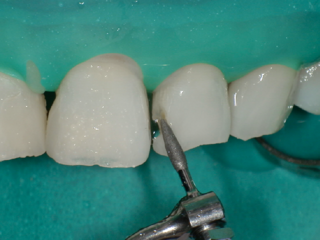 窩縁部を滑らかに整理。