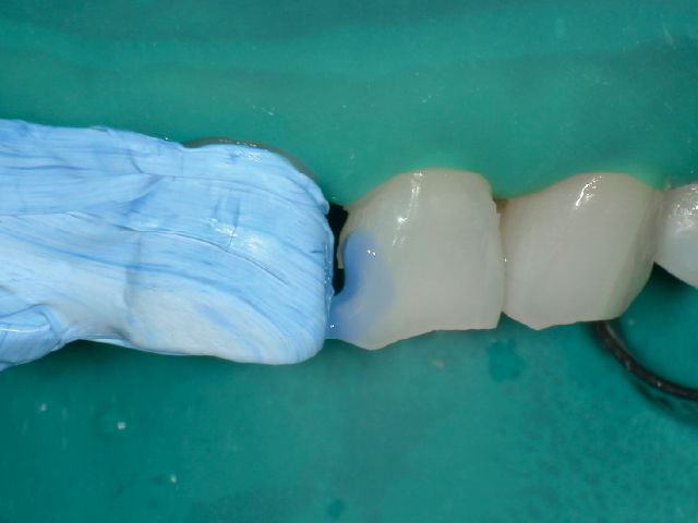 窩縁部エナメル質へのリン酸エッチング処理。