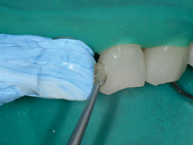 2ステップタイプのセルフエッチングシステムによる接着操作。