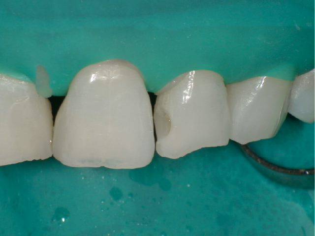 積層充填の第1層目として、窩洞底部へのフロアブルCRの充填。