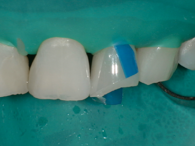 積層充填の第2層目として、3Dクリアマトリックス内へのフロアブルタイプCRの充填。