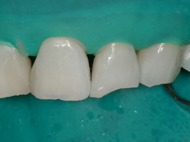 充填操作完了後。