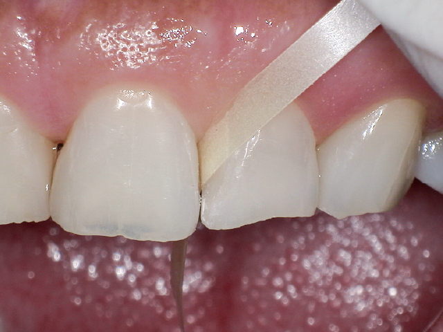 形態修正・研磨操作。