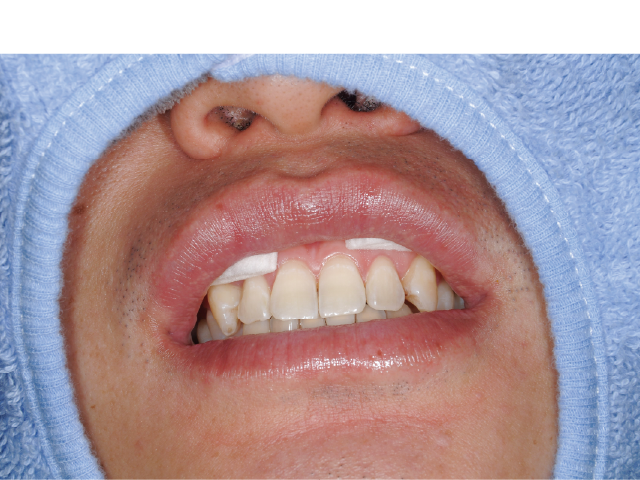 図1: アングルワイダーを痛がる患者さんには、ロールワッテで代用。