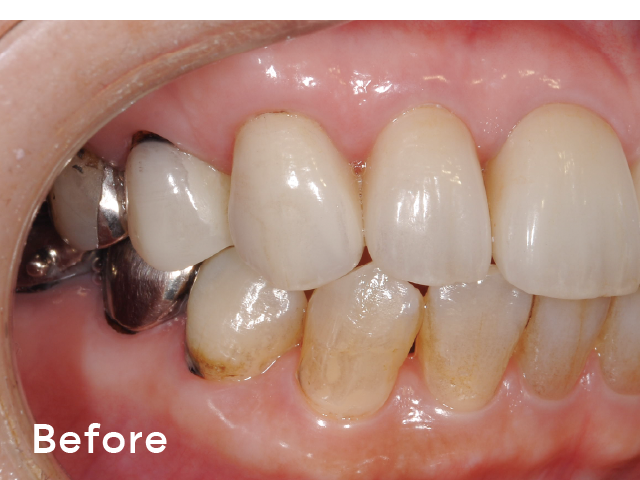 図4-1 : 軽微なステインと補綴装置が混在している症例。ソフトパールを使用することで短時間で効率よく施術できた。