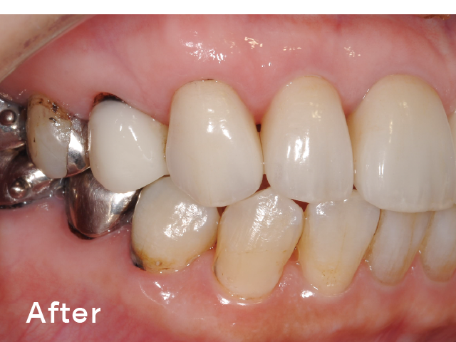 図4-2 : 軽微なステインと補綴装置が混在している症例。           ソフトパールを使用することで短時間で効率よく施術できた。