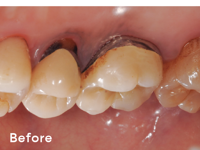 図5-1 : 口蓋側隣接面の喫煙によるステインの症例。「ソフトパール」を使用し、補綴装置についているステインまで、除去することができた。