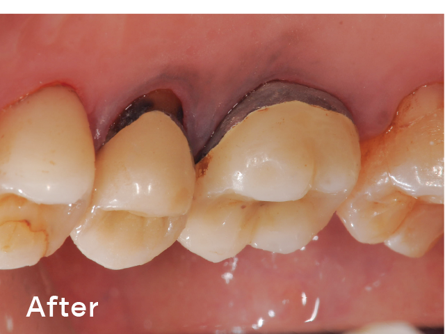 図5-2 : 口蓋側隣接面の喫煙によるステインの症例。「ソフトパール」を使用し、補綴装置についているステインまで、除去することができた。